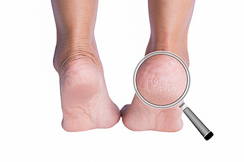 Dry cracked heels causes hotsell